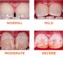 what_is_fluorosis